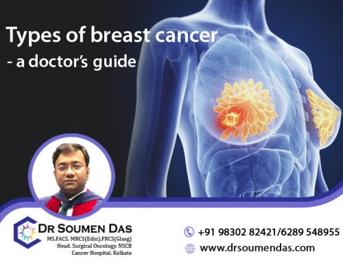 Types of breast cancer- a doctor’s guide