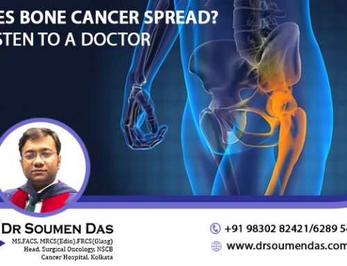 Does bone cancer spread? – listen to a doctor