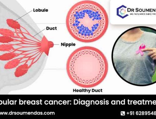 Lobular breast cancer: Diagnosis and treatment